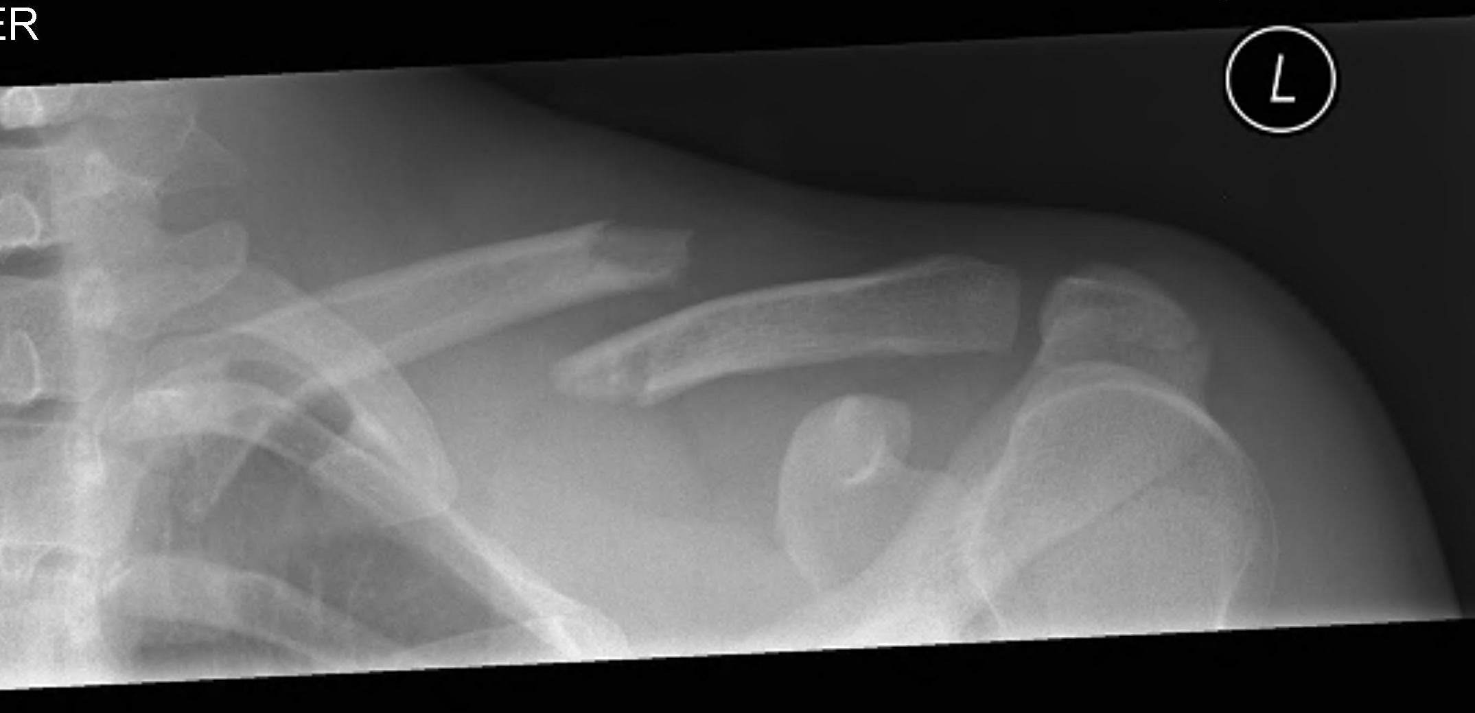 Clavicle Diaphysis Fracture